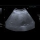 Steatosis of liver, steatosis hepatis, fatty liver, parenchymal sparing: US - Ultrasound
